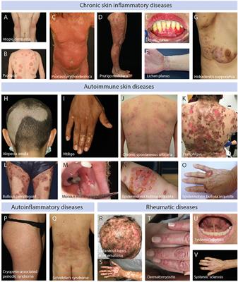 Unmet Medical Needs in Chronic, Non-communicable Inflammatory Skin Diseases